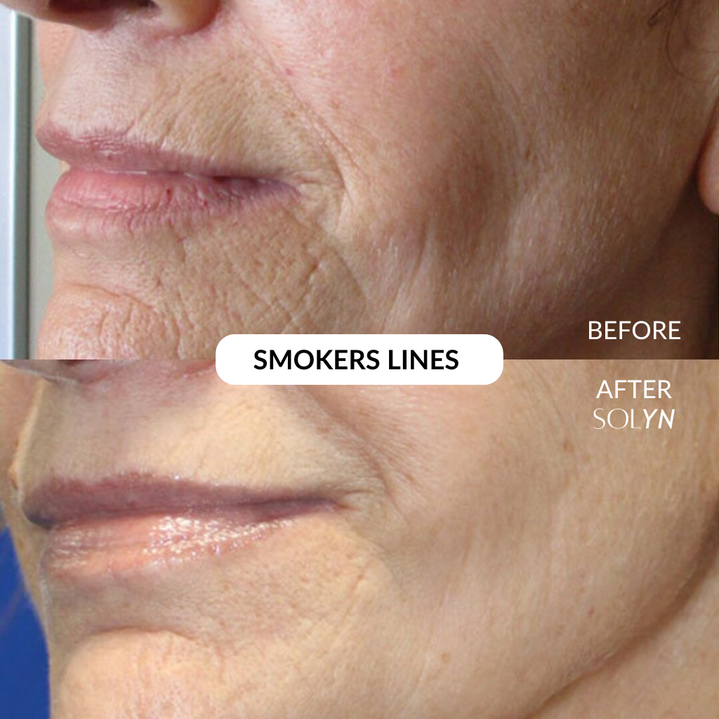Solyn® PDRN Pink Collagen Cream - BOGO Sale